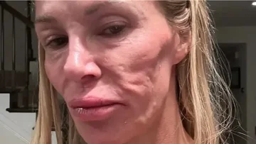 Ish-modelja tregon si i shpërthyen implantet e gjoksit dhe i shpërfytyruan fytyrën: U plaka 20 vite brenda natës